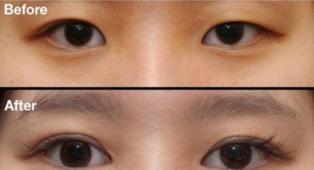 呼和浩特開(kāi)眼角"