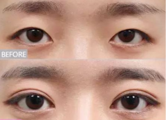 ���ͺ������θ��p��Ƥ��������g�Ƕ�����