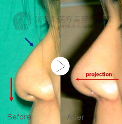 呼和浩特整形隆鼻