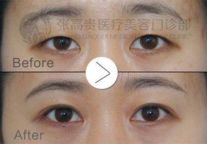 呼市整形雙眼皮