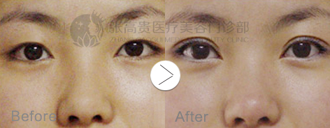 呼和浩特雙眼皮