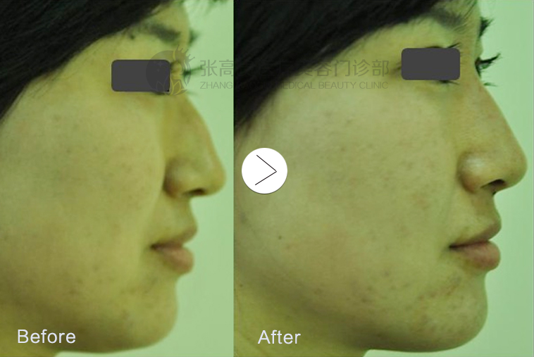 鷹鉤鼻治療前后