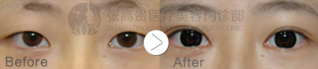 呼和浩特整形雙眼皮