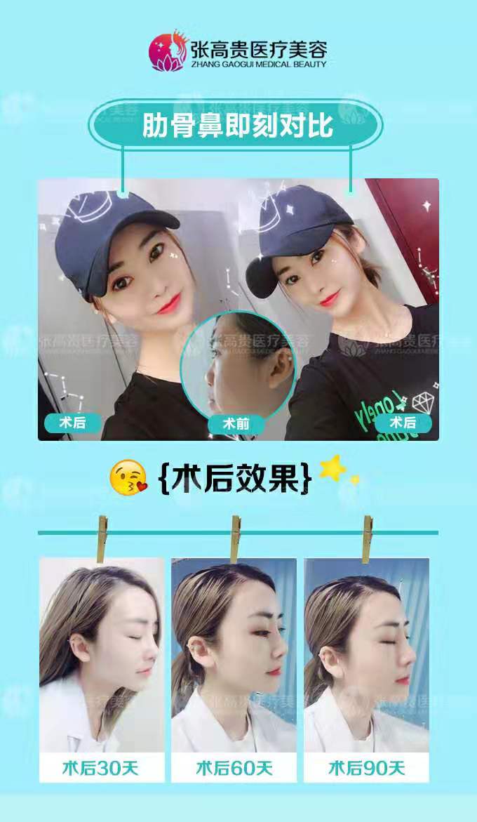 呼市整形隆鼻 style=