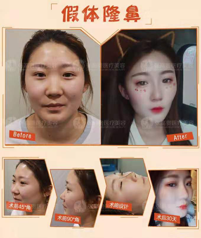 呼市隆鼻哪家好