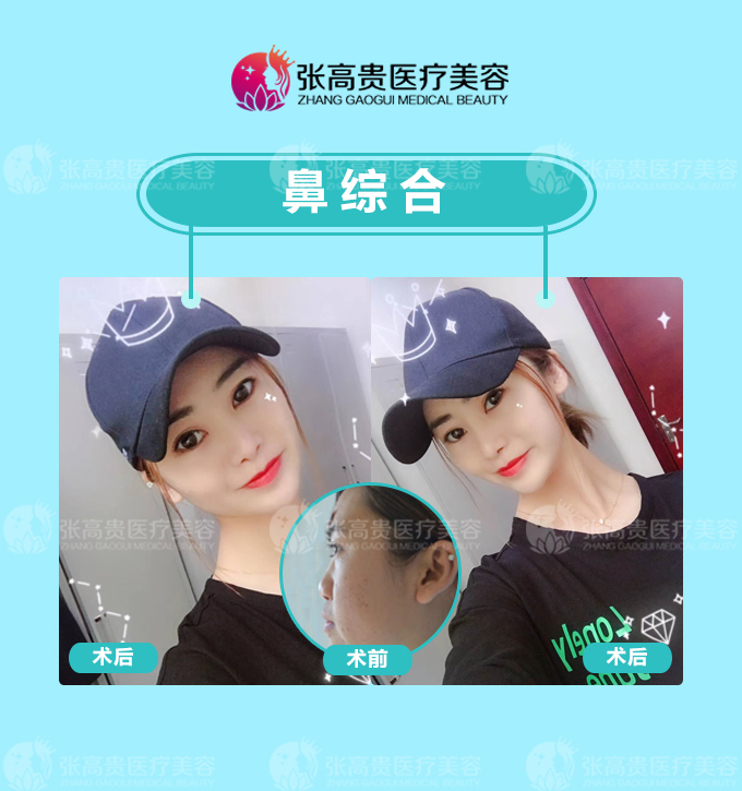 ��������¡��