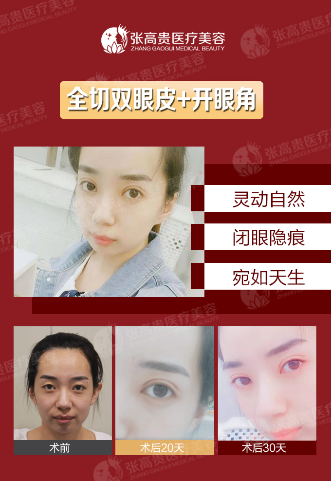 呼和浩特雙眼皮