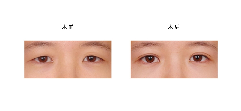 雙眼皮