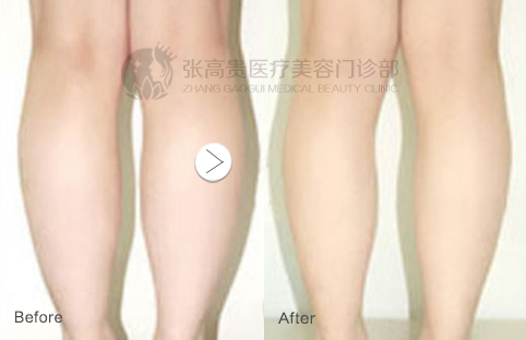 瘦小腿1