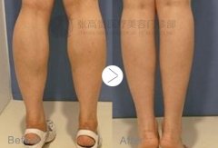 ����С����֬�p��Ҫע������(xi��ng)����Щ��