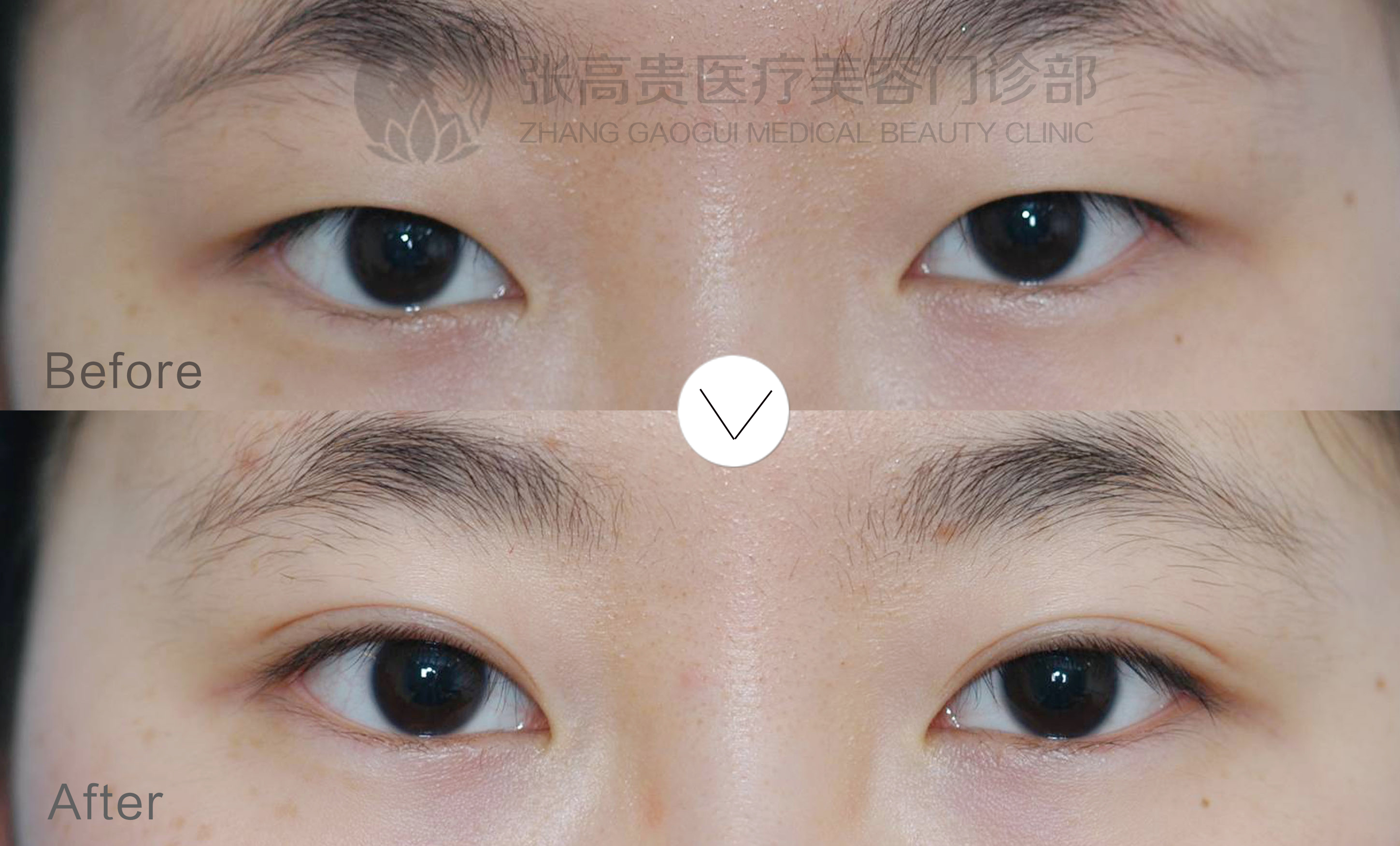 �nʽ΢��(chu��ng)�p��Ƥ