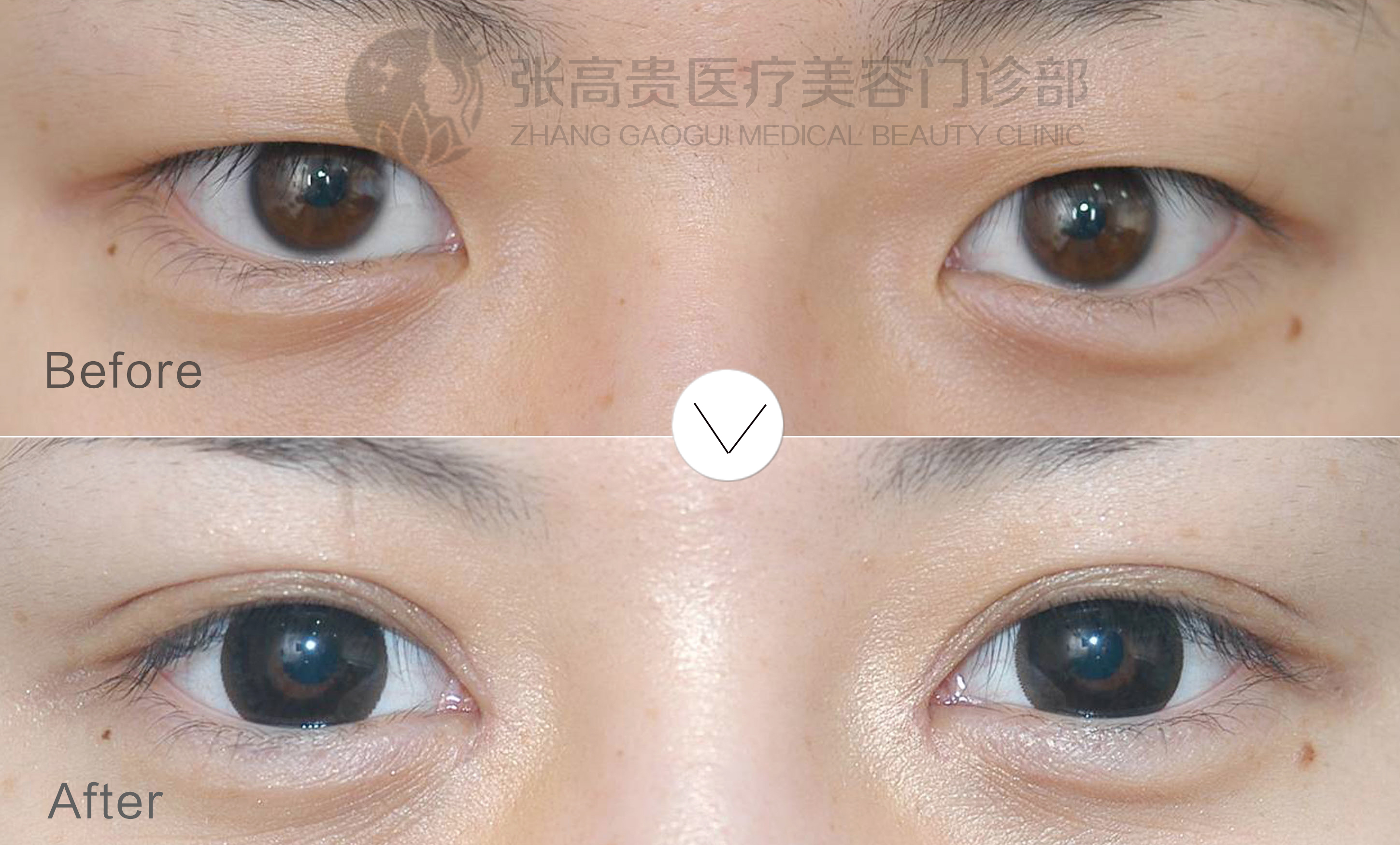 雙眼皮開(kāi)眼角