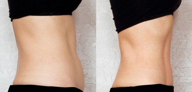 呼市整形醫(yī)院吸脂