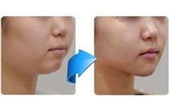 ���w֬��¡�°����g(sh��)ǰ��(zh��n)�乤����ʲô��