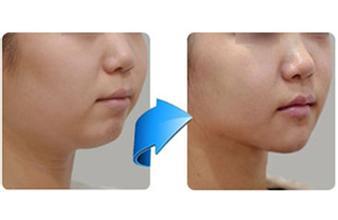 呼市整形醫(yī)院隆下巴