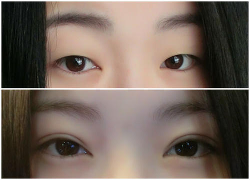 呼市整形醫(yī)院雙眼皮