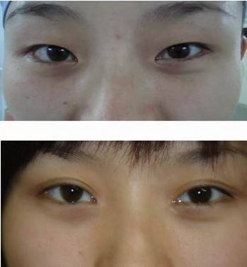 呼市整形醫(yī)院雙眼皮