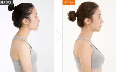 呼市整形醫(yī)院 豐胸