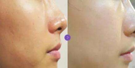 呼市整形醫(yī)院 水光針