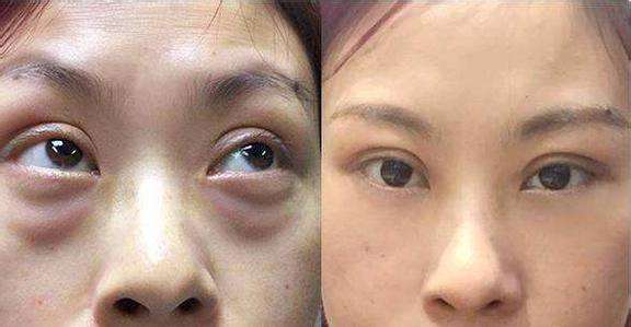 呼市整形醫(yī)院祛眼袋