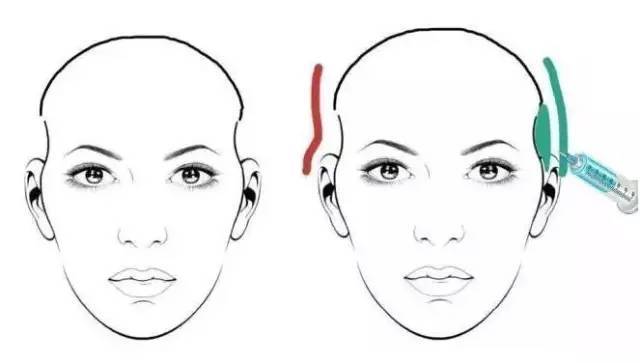 太陽(yáng)穴填充