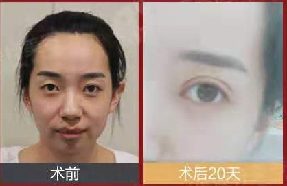 呼市整形雙眼皮哪家好