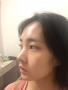 呼和浩特做自體脂肪豐太陽穴價格貴嗎