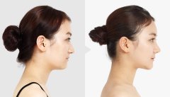 呼市做自體脂肪豐額頭的適應人群有哪些?