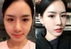 雙眼皮修復(fù)手術(shù)成功率高嗎